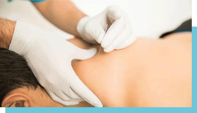 dry-needling-explication-jette-kinesitherapie-kine