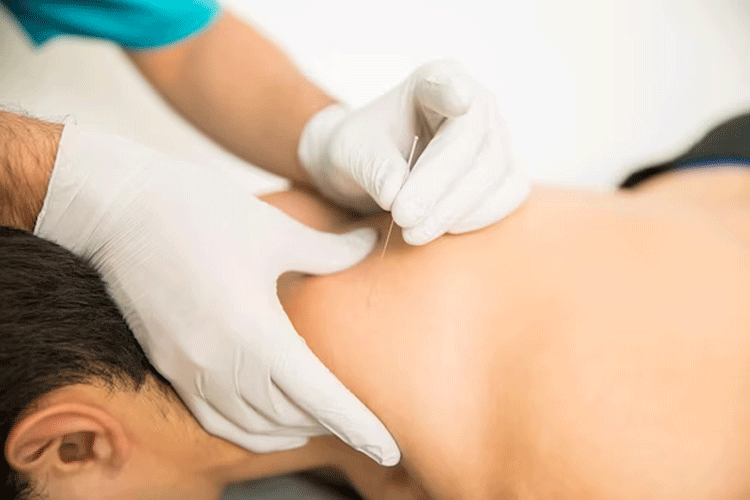 dry-needling-kine-jette-kinesitherapie-samuel-prevot-choupas